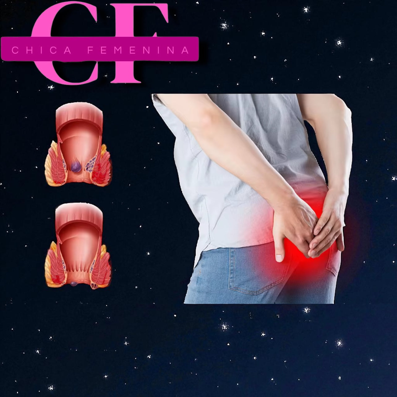 CREMA PARA HEMORROIDE HYCHXCC