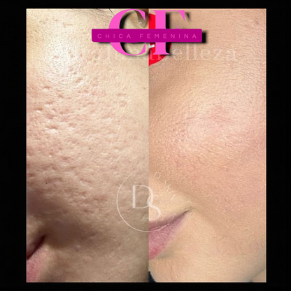 SERUM ACIDO SALICILICO 30 MLREMOVEDOR DE ACNE